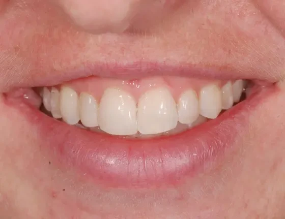 fts invisalign straightening case1 after