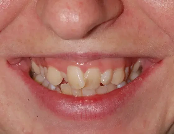 fts invisalign straightening case1 before