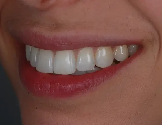 fts invisalign straightening case2 after