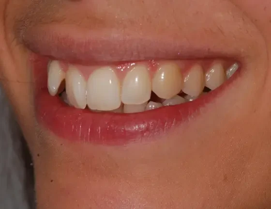 fts invisalign straightening case2 before