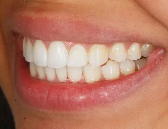 fts invisalign straightening case3 after