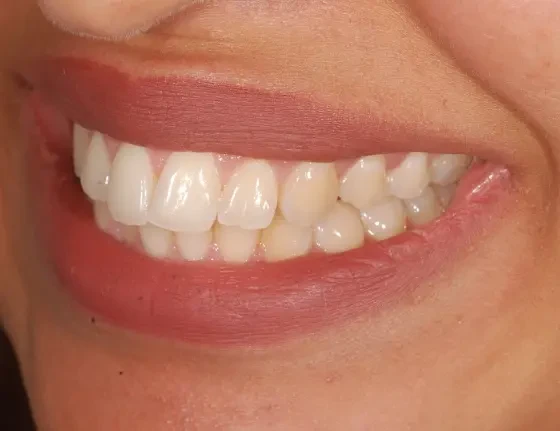 fts invisalign straightening case3 before
