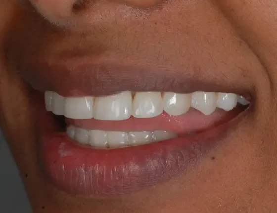 fts invisalign straightening case4 after
