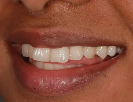 fts invisalign straightening case4 before