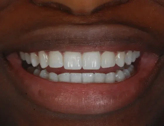 fts invisalign straightening case1 after