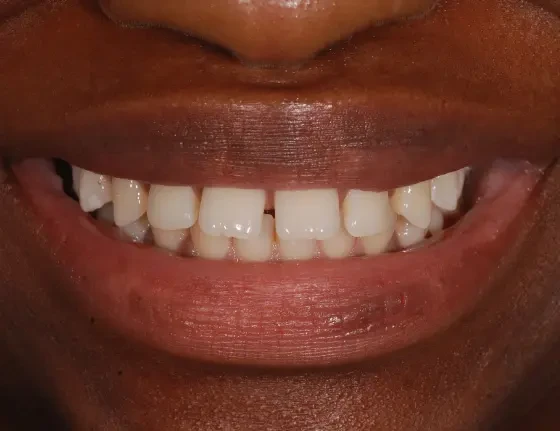 fts invisalign straightening case1 before
