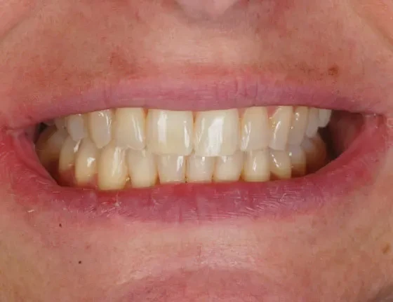 fts invisalign straightening case1 after