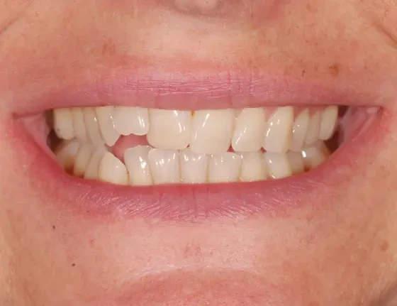 fts invisalign straightening case1 before