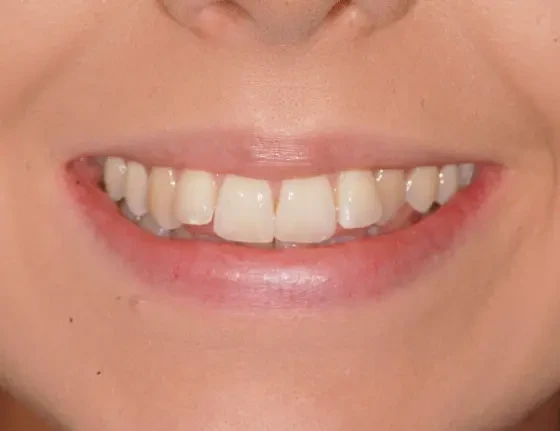 fts invisalign straightening case8 before