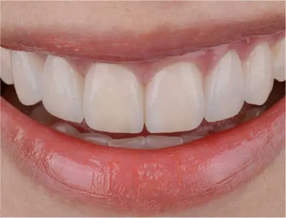 fts invisalign straightening case9 after