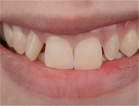 fts invisalign straightening case9 before